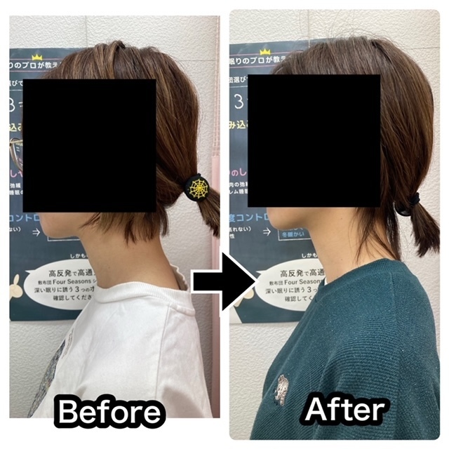 さくら整骨院でスマホ首を改善させた30代女性のビフォーアフター写真004