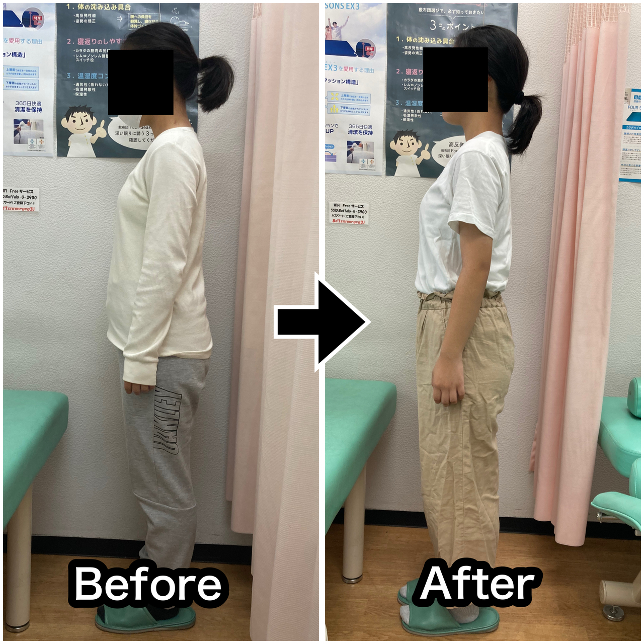 さくら整骨院で首の痛みを改善した14歳の女の子のビフォーアフター写真