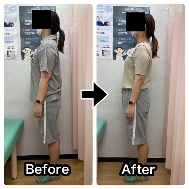 慢性的な腰痛をさくら整骨院で改善させた30代女性会社員の比較画像