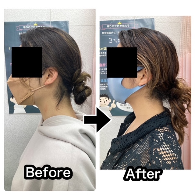 さくら整骨院でスマホ首を改善させた30代女性のビフォーアフター写真003