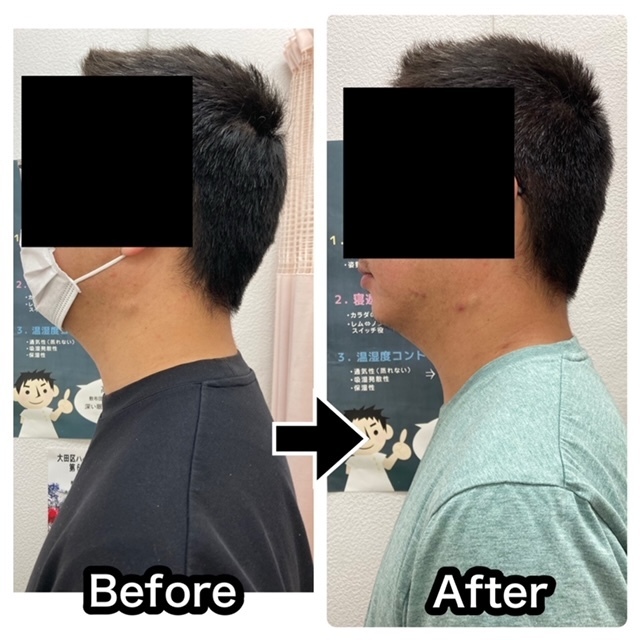 さくら整骨院で首の痛みを改善した30代男性経営者のビフォーアフター写真