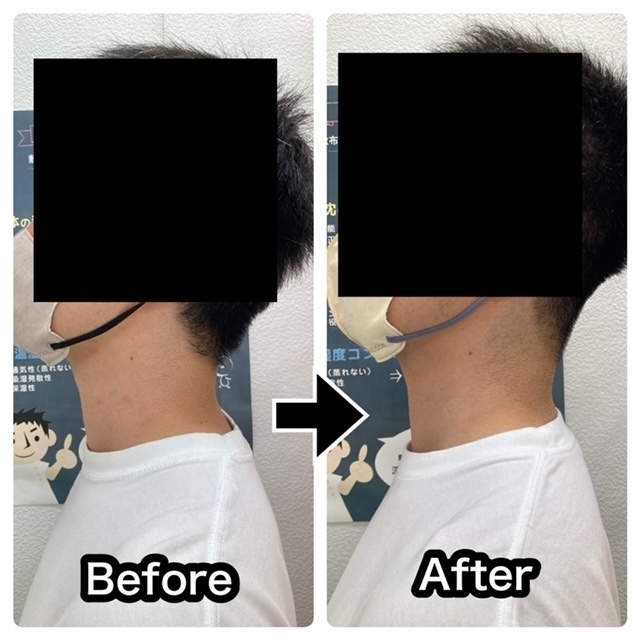 さくら整骨院でスマホ首を改善させた40代男性のビフォーアフター写真002