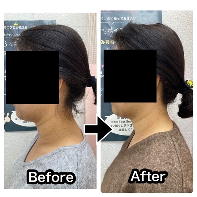 さくら整骨院でスマホ首を改善させた40代女性のビフォーアフター写真001