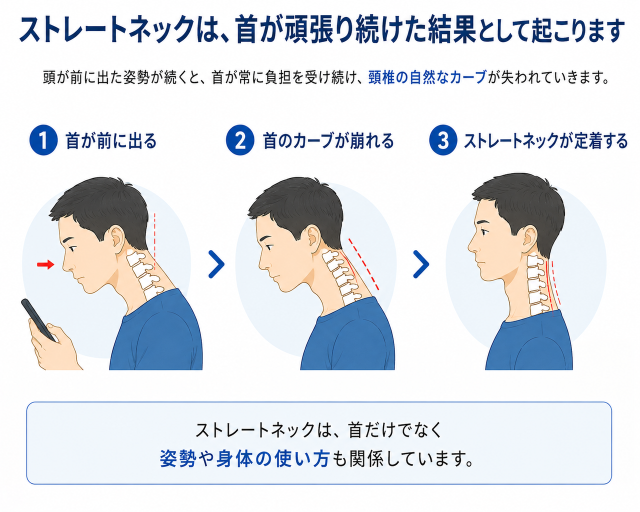 ストレートネックが代償的に起こる過程を3段階で解説。頭と背骨が前に倒れ、下位頸椎が屈曲し、視線を戻すために上位頸椎が伸展してストレートネックとなる。