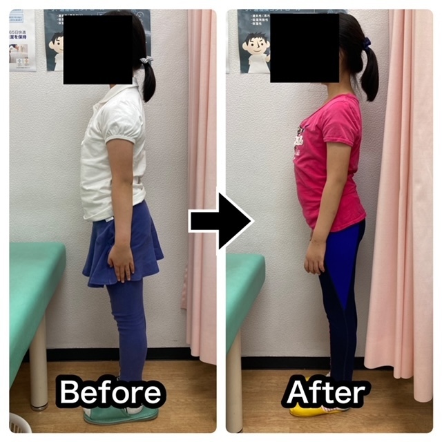 さくら整骨院で首の痛みを改善した8歳の女の子のビフォーアフター写真